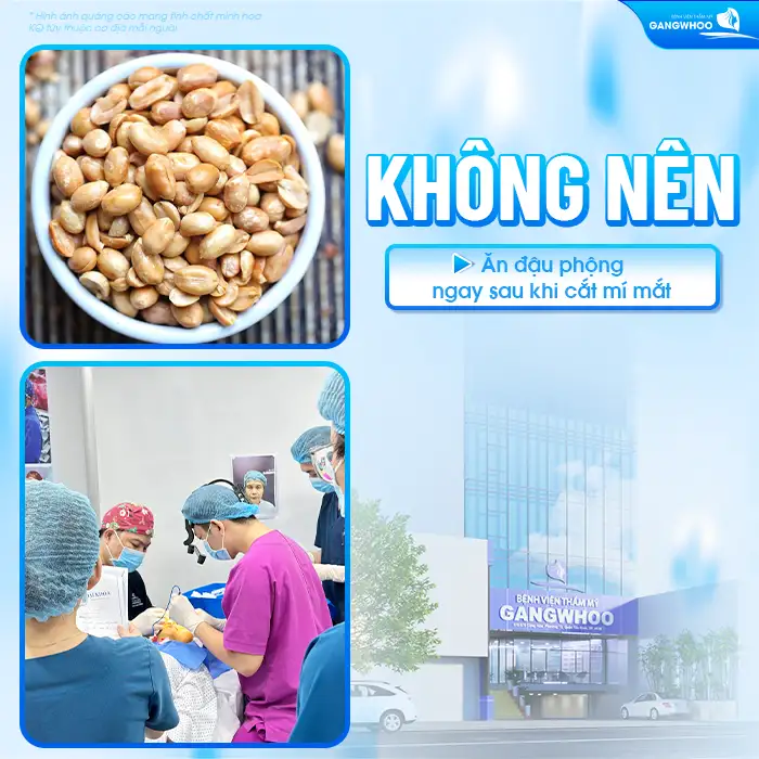 Cắt mí mắt có ăn đậu phộng được không? Nên kiêng đậu phộng bao lâu?