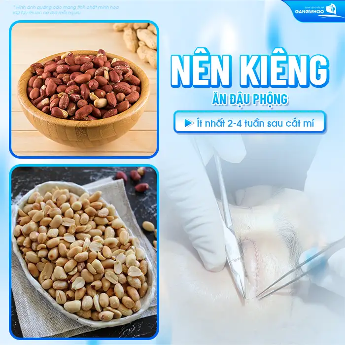 Cắt mí mắt có ăn đậu phộng được không? Nên kiêng đậu phộng bao lâu?