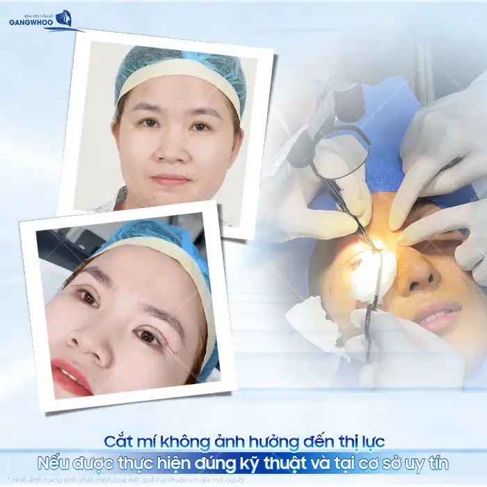 Cắt mí mắt có ảnh hưởng đến thị lực không? Cần lưu ý những gì?