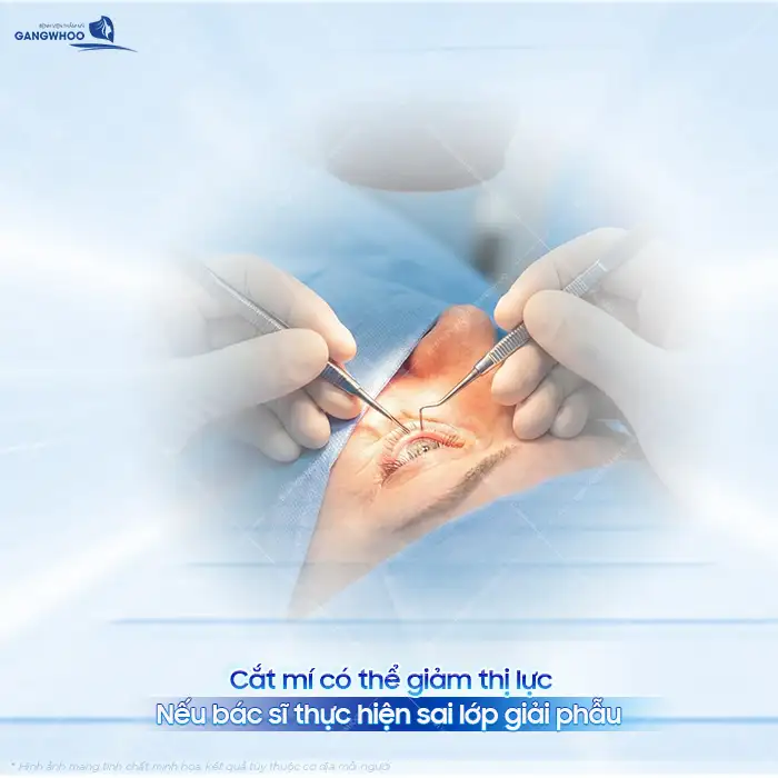 Cắt mí mắt có ảnh hưởng đến thị lực không? Cần lưu ý những gì?