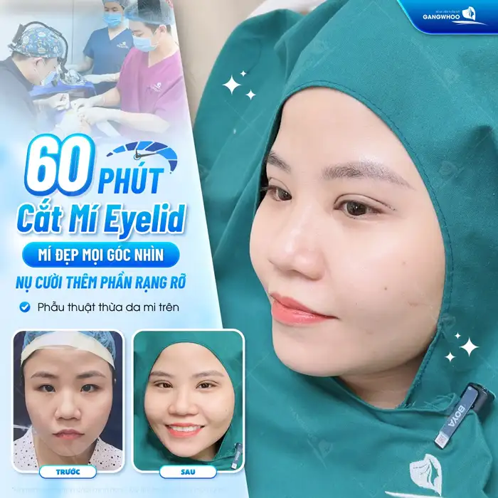 Cắt mí mắt có ảnh hưởng đến thị lực không? Cần lưu ý những gì?