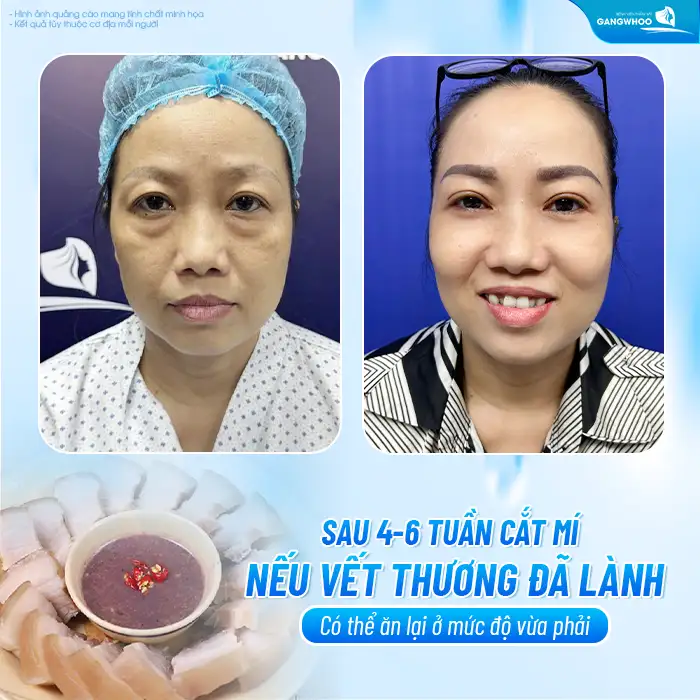 Cắt mí mắt có được ăn mắm tôm không? Bao lâu thì được ăn mắm tôm