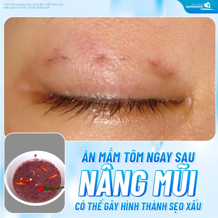 Cắt mí mắt có được ăn mắm tôm không? Bao lâu thì được ăn mắm tôm