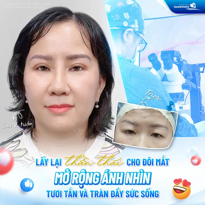 Cắt mí mắt cười là gì? Những ai phù hợp để cắt mí mắt cười