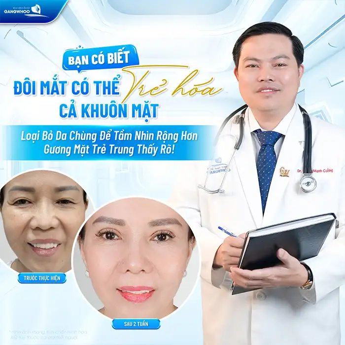 Cắt mí mắt cười là gì? Những ai phù hợp để cắt mí mắt cười