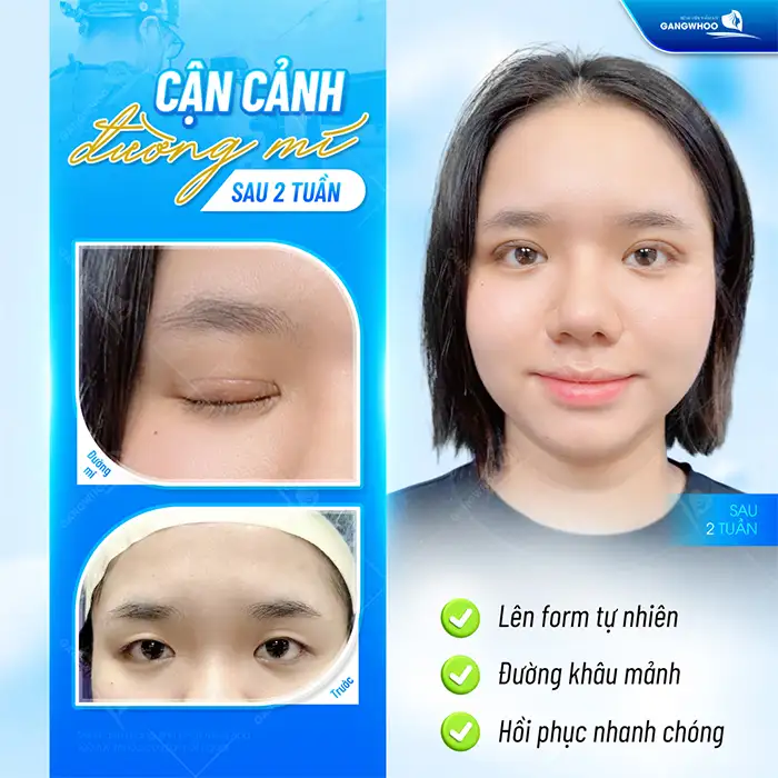 Cắt mí mắt cười là gì? Những ai phù hợp để cắt mí mắt cười