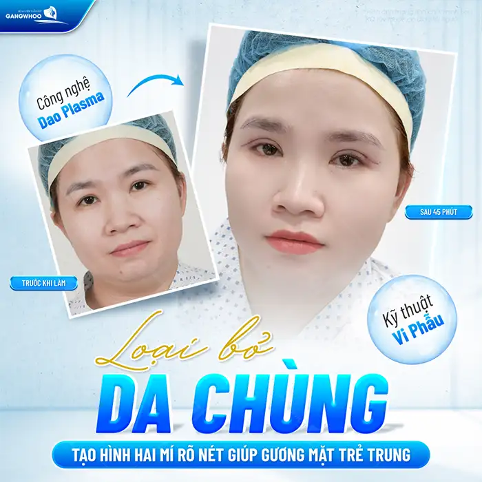 Cắt mí mắt không cần phẫu thuật có những phương pháp nào?