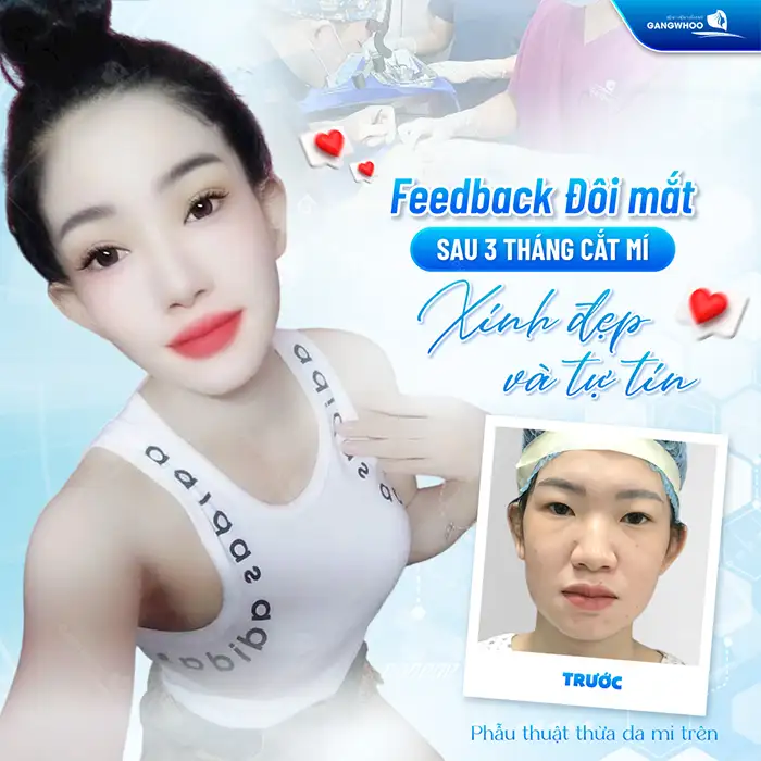 Cắt mí mắt không cần phẫu thuật có những phương pháp nào?