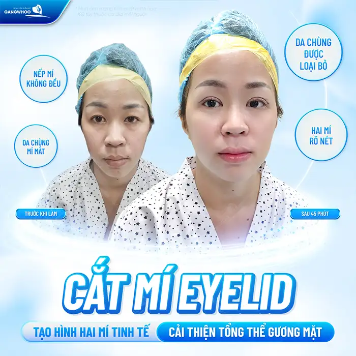 Cắt mí mắt không cần phẫu thuật có những phương pháp nào?