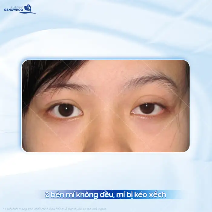 Cắt mí mắt quá dài nguyên nhân do đâu? Cách khắc phục ra sao?