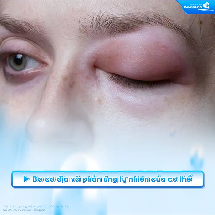 Vì sao cắt mí mắt sưng không đều? Cách xử lý ra sao?