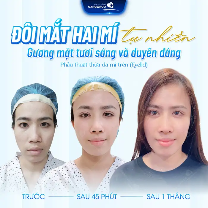 Cắt mí mini deep bao lâu thì hết sưng? Thời gian hồi phục bao lâu