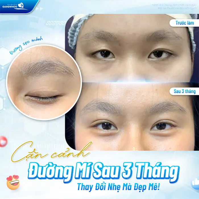Cắt mí mini deep có được vĩnh viễn không? Phụ thuộc vào yếu tố nào?