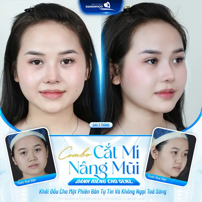 Cắt mí mini deep có được vĩnh viễn không? Phụ thuộc vào yếu tố nào?