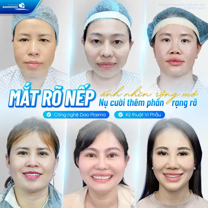 Cắt mí mini deep có được vĩnh viễn không? Phụ thuộc vào yếu tố nào?