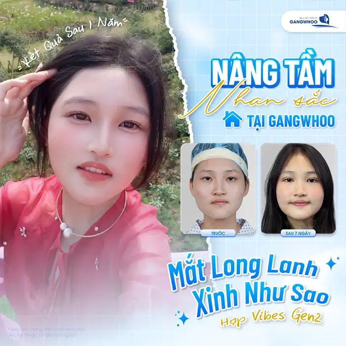 Cắt mí mini deep giữ được bao lâu? Có giữ được vĩnh viễn không?