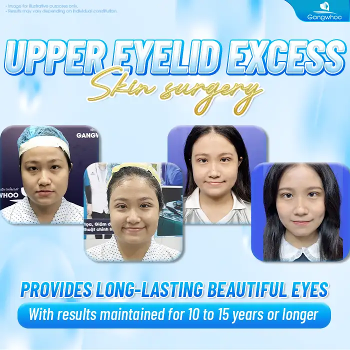 Cắt mí mini deep giữ được bao lâu? Có giữ được vĩnh viễn không?