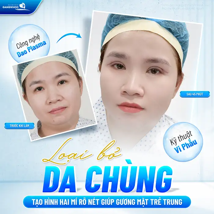 Cắt mí mini deep ở đâu đẹp? Tham khảo 5 địa chỉ cắt mí mini deep an toàn