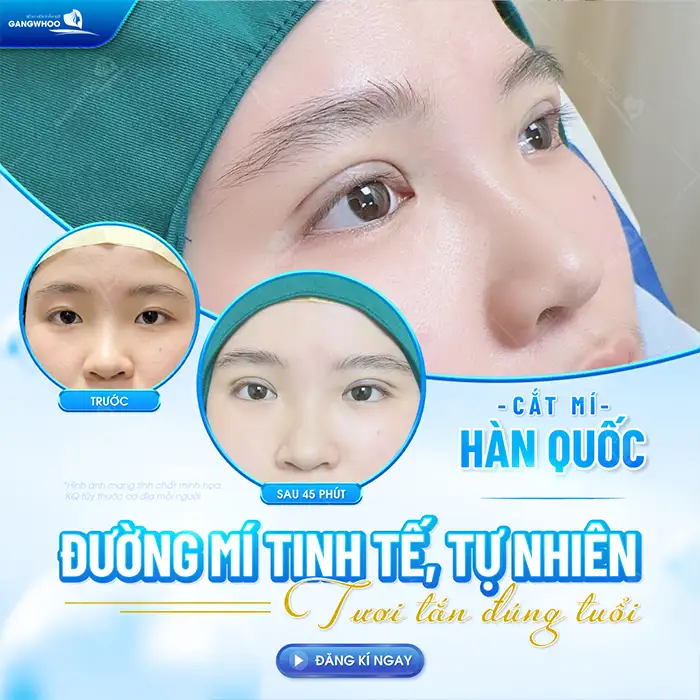 Cắt mí mini deep ở đâu đẹp? Tham khảo 5 địa chỉ cắt mí mini deep an toàn