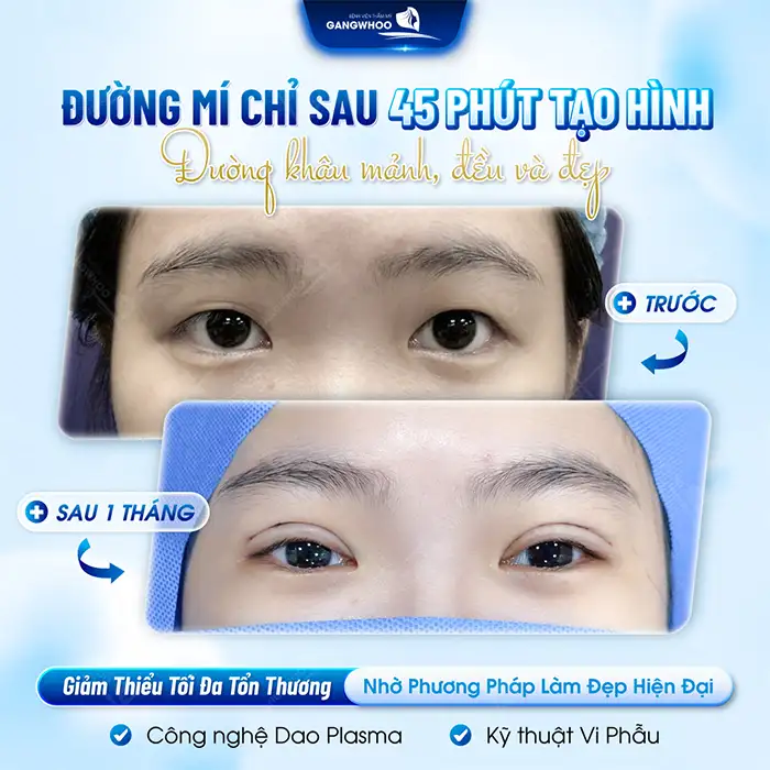 Cắt mí Open Deep là gì? Cắt mí Mini Deep có gì khác so với Open Deep