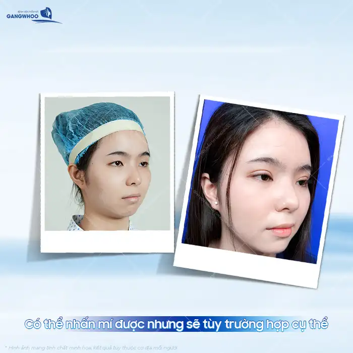 Cắt mí rồi có nhấn mí được không? Sau bao lâu thì nhấn mí được?