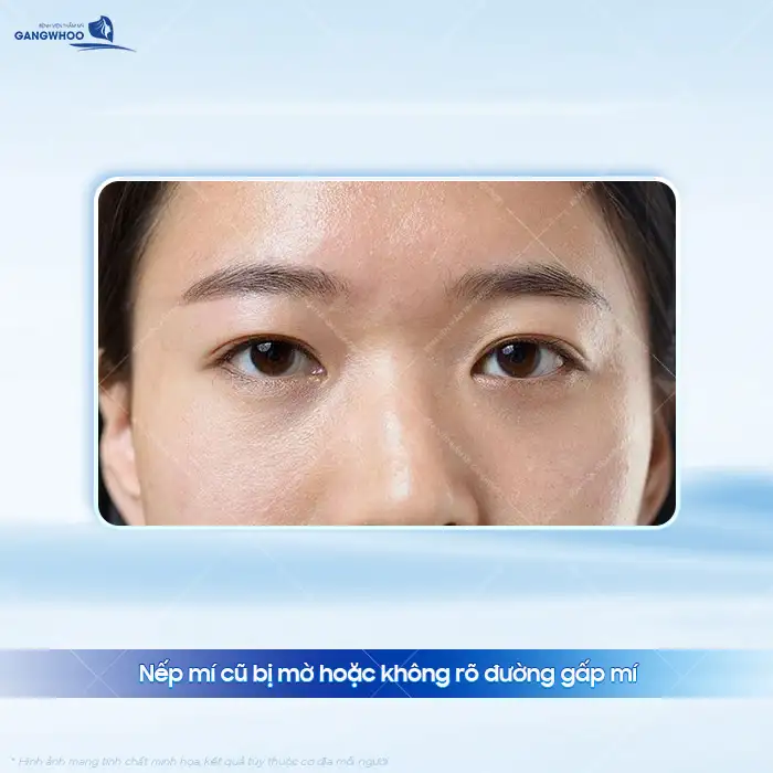 Cắt mí rồi có nhấn mí được không? Sau bao lâu thì nhấn mí được?