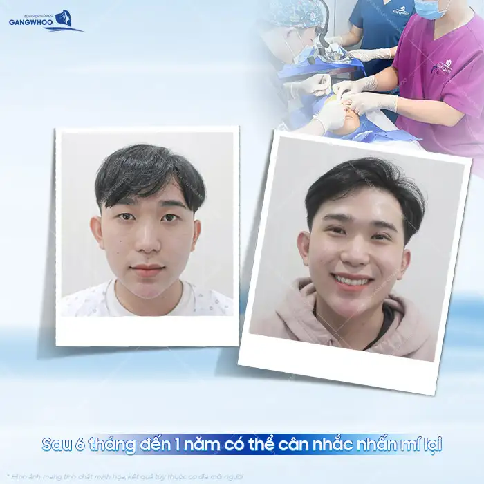 Cắt mí rồi có nhấn mí được không? Sau bao lâu thì nhấn mí được?