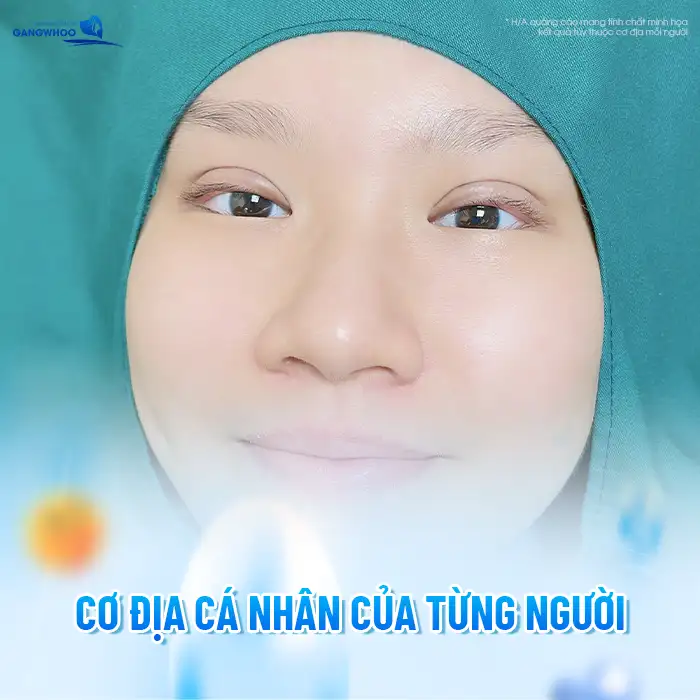 Tại sao cắt mí sau 1 tháng vẫn sưng to? Nguyên nhân do đâu?