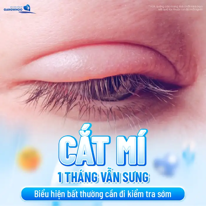 Tại sao cắt mí sau 1 tháng vẫn sưng to? Nguyên nhân do đâu?