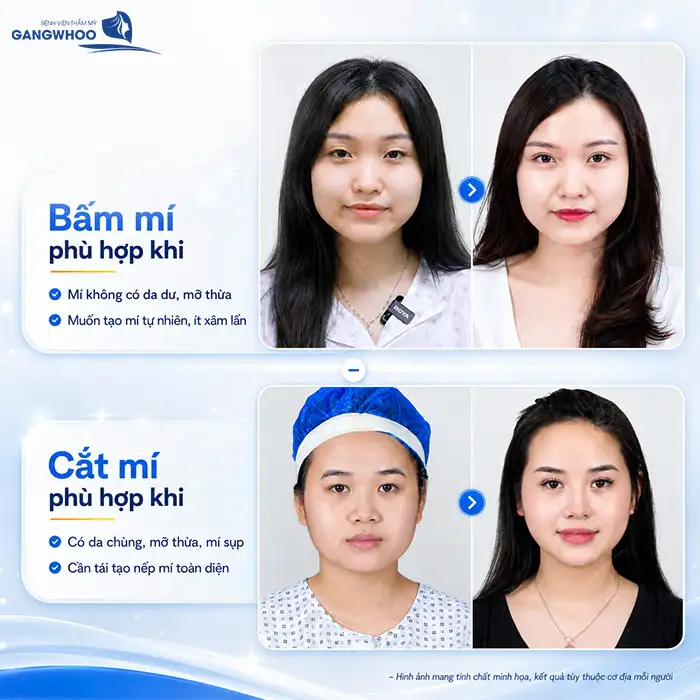 Cắt mí và bấm mí khác nhau như thế nào? Nên bấm mí hay cắt mí