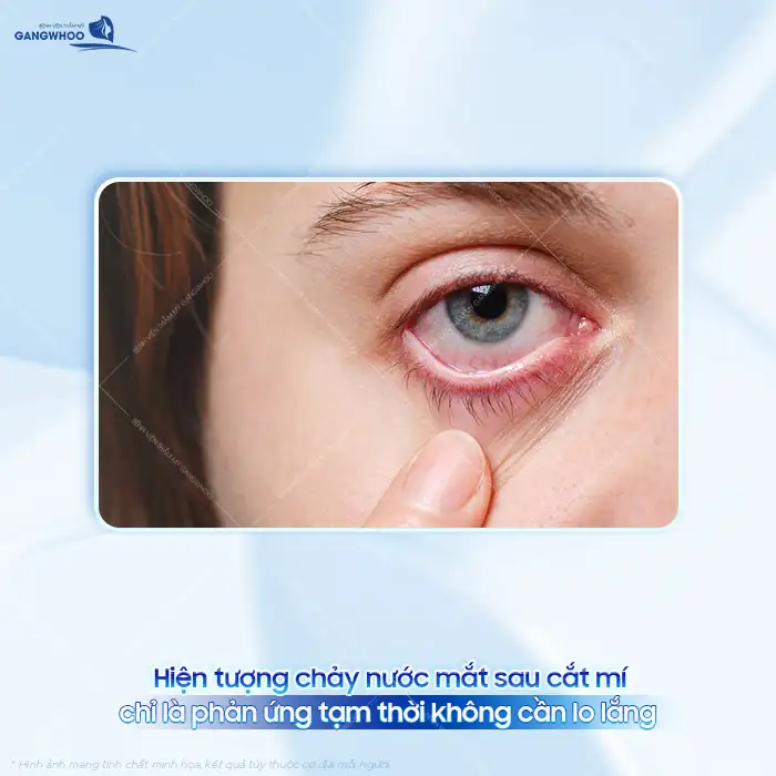 Cắt mí xong bị chảy nước mắt nguyên nhân do đâu? Cách khắc phục ra sao?