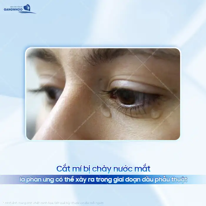 Cắt mí xong bị chảy nước mắt nguyên nhân do đâu? Cách khắc phục ra sao?