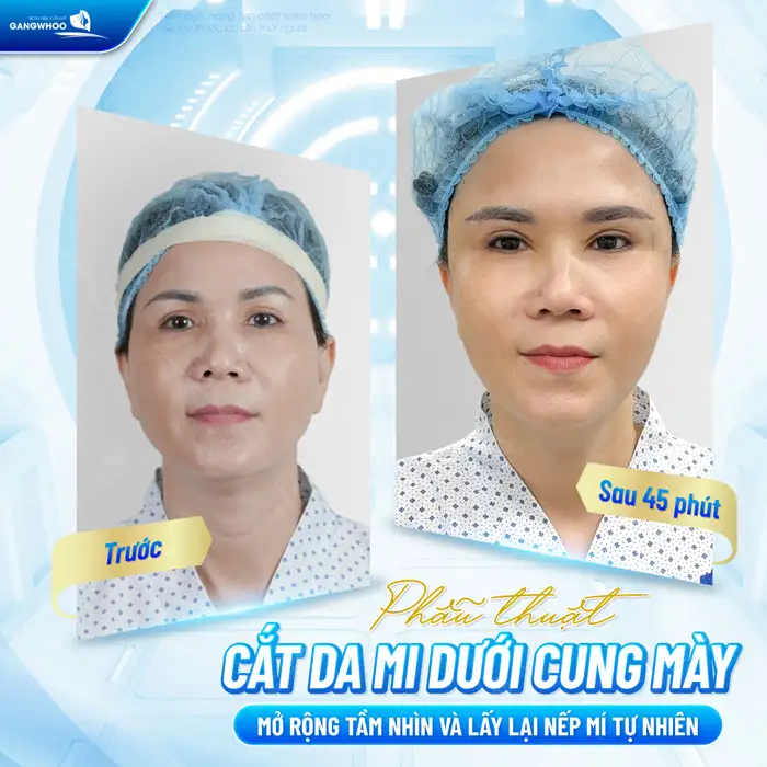 Cắt treo mí mắt là gì? Có giúp mở rộng góc mắt không?