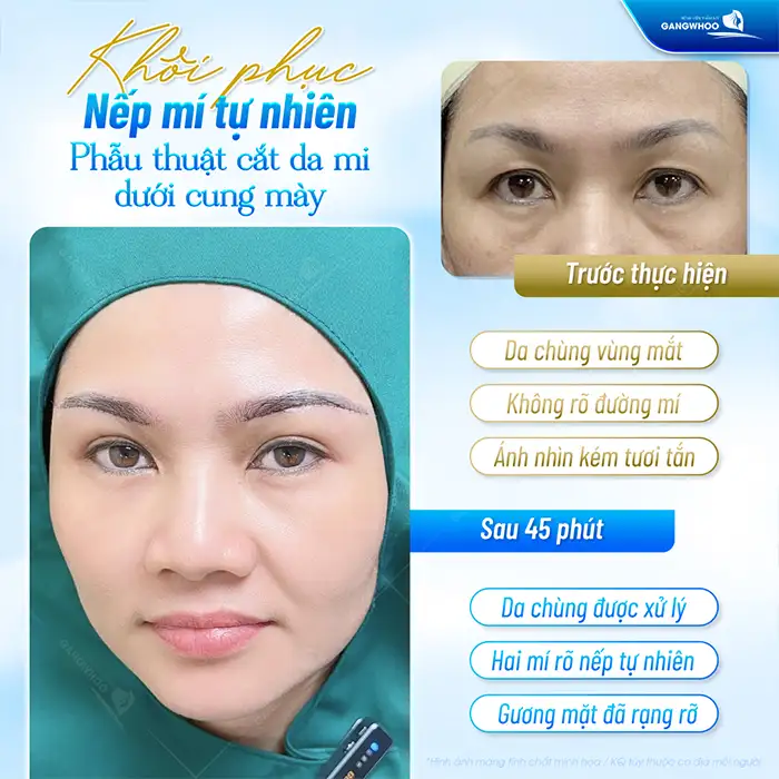 Cắt treo mí mắt là gì? Có giúp mở rộng góc mắt không?