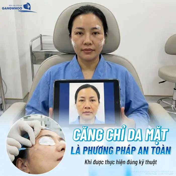 Cấy chỉ căng da mặt có tốt không? Có duy trì được lâu dài?