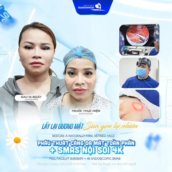 Cấy sợi siêu vi căng bóng da mặt là gì? Ưu, nhược điểm của phương pháp