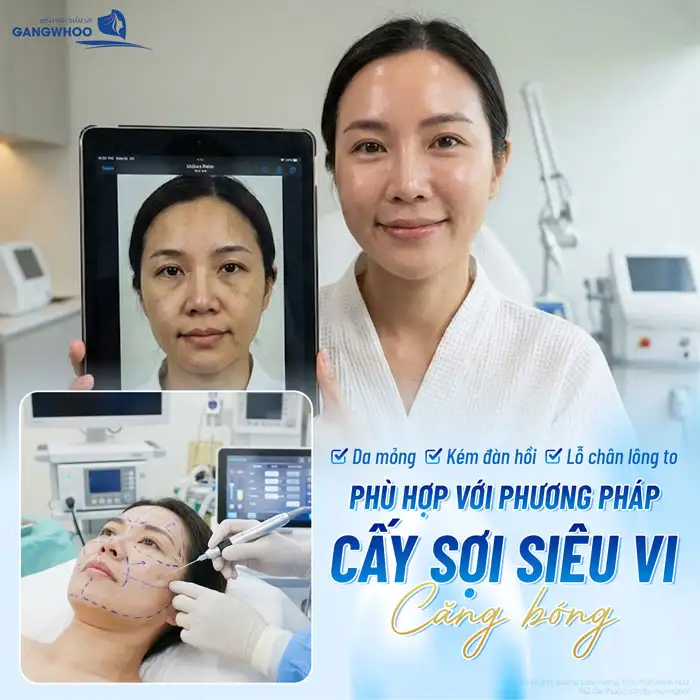 Cấy sợi siêu vi căng bóng da mặt là gì? Ưu, nhược điểm của phương pháp
