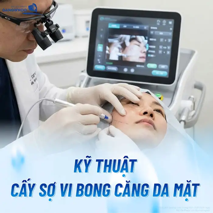 Cấy sợi siêu vi căng bóng da mặt là gì? Ưu, nhược điểm của phương pháp