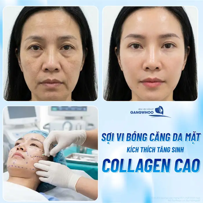 Cấy sợi siêu vi căng bóng da mặt là gì? Ưu, nhược điểm của phương pháp