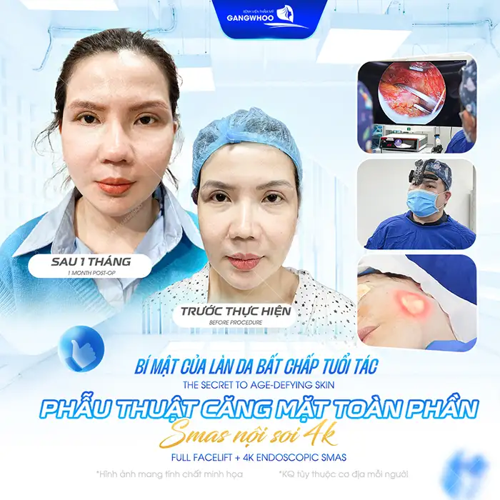 Phương pháp châm cứu làm căng da mặt là gì? Có thật sự hiệu quả