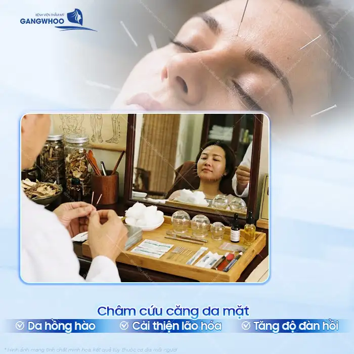 Phương pháp châm cứu làm căng da mặt là gì? Có thật sự hiệu quả