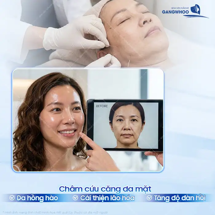 Phương pháp châm cứu làm căng da mặt là gì? Có thật sự hiệu quả