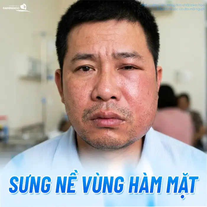 Chăm sóc sau gọt hàm đúng cách giúp mau lành và giảm sưng nhanh