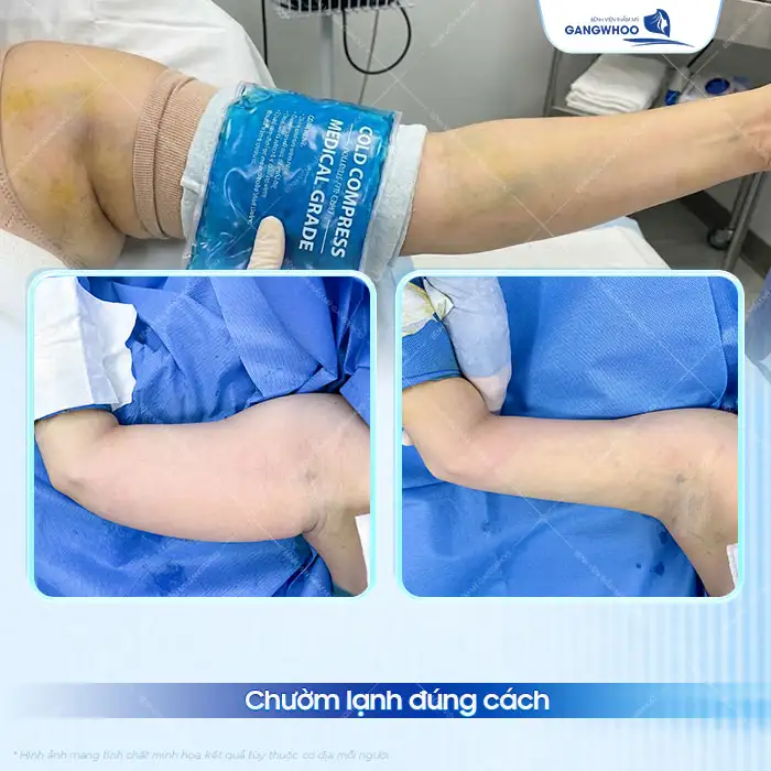 Chăm sóc sau hút mỡ bắp tay đúng cách giúp nhanh hồi phục, giữ dáng đẹp