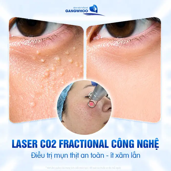 Chi phí điều trị mụn thịt bao nhiêu? Bảng giá điều trị mụn mới 2025