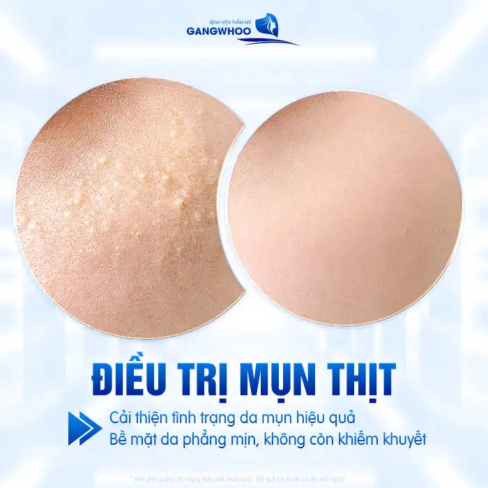 Chi phí điều trị mụn thịt bao nhiêu? Bảng giá điều trị mụn mới 2025