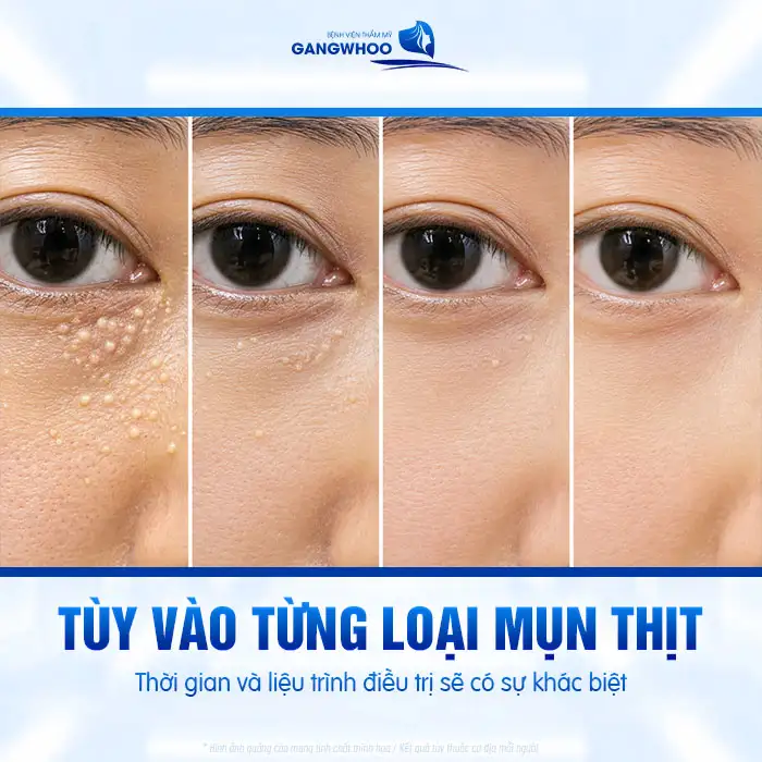 Chi phí điều trị mụn thịt bao nhiêu? Bảng giá điều trị mụn mới 2025