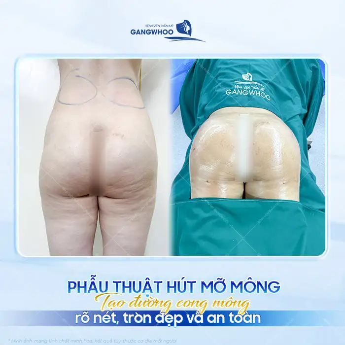 Chi phí hút mỡ mông hiện nay là bao nhiêu? Bảng giá cập nhật 2025