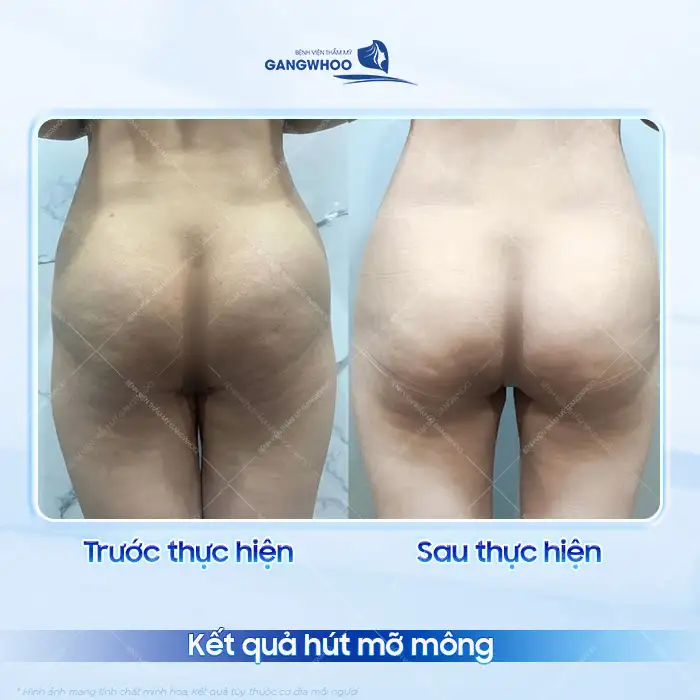 Chi phí hút mỡ mông hiện nay là bao nhiêu? Bảng giá cập nhật 2025