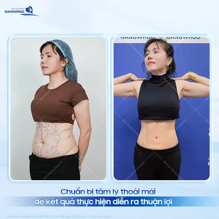 Chia sẻ kinh nghiệm đi hút mỡ để đảm bảo an toàn, hiệu quả